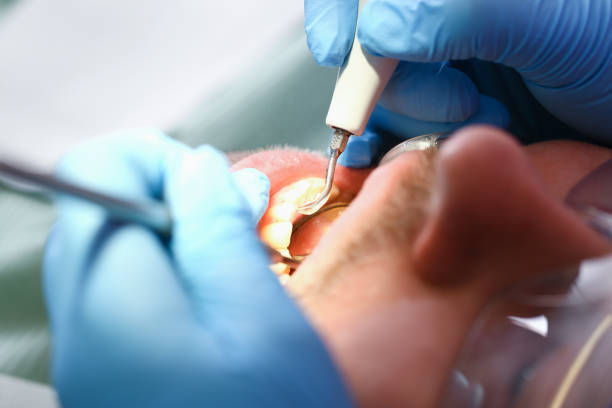 Best Emergency Tooth Extraction in Yermo, CA