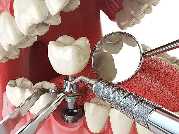 Best Emergency Root Canal Treatment in Yermo, CA